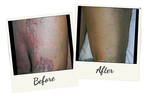 laser-vein-therapy-2