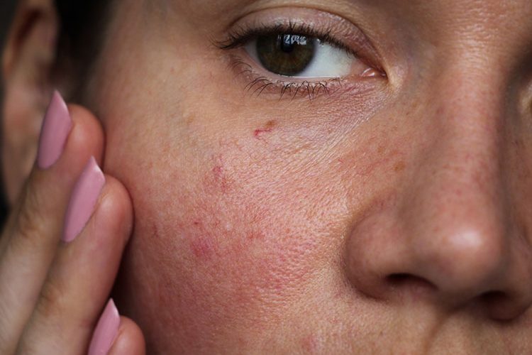 Causes of Uneven Skin | Riopelle Cosmetic Surgery and Laser Center